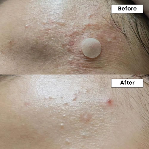 Nine Less A-c10% Azelaic Control Del Acné, Brotes Y Manchas