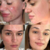 Medicube Red Succinic Acid Serum Para Piel Con Acné Y Marcas