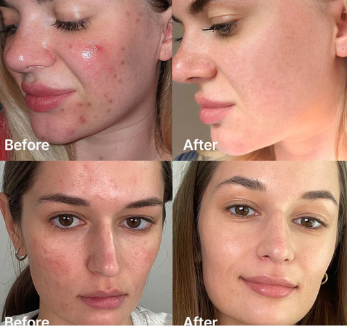 Medicube Red Succinic Acid Serum Para Piel Con Acné Y Marcas