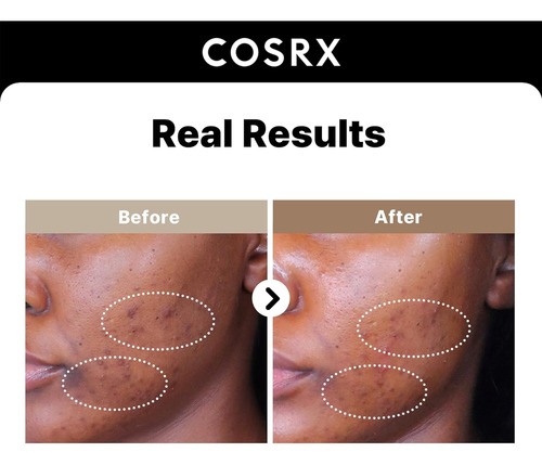 Cosrx The Alpha-arbutin 2 Serum Aclara Cicatrices Post-acné Todo Tipo De Piel Día/noche